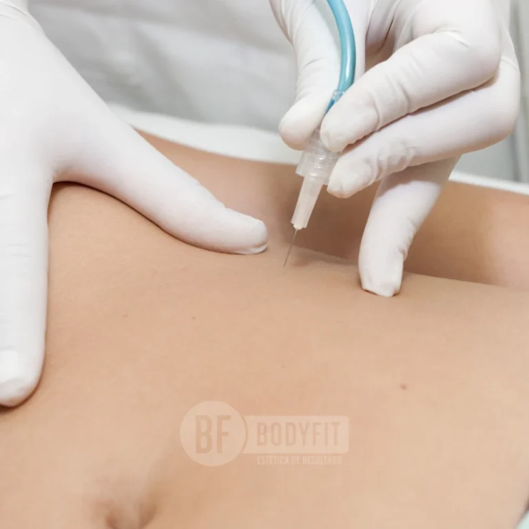 carboxiterapia corporal
